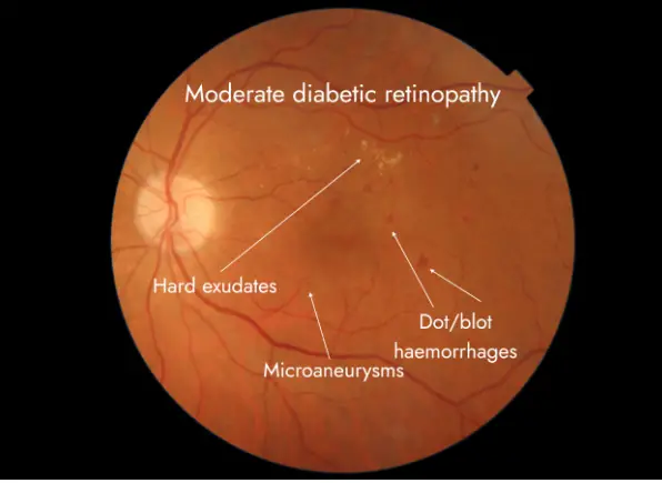 Free Data Science Project: Diabetic Retinopathy Detection using Python